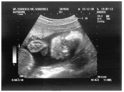 Ultrasound 19July2013a